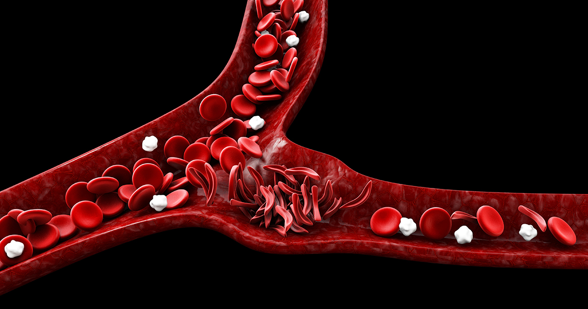 Cell Therapy: Sickle Cell Disease